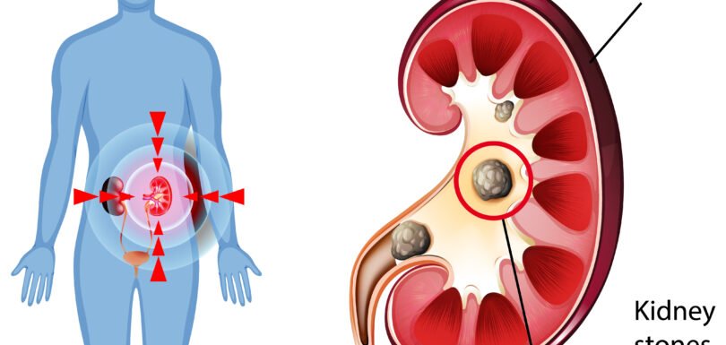 Kidney Stone Surgery in Mohali
